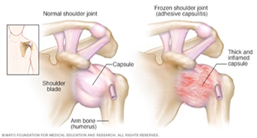 Frozen Shoulder Massage: Trigger Points & 10 Recommended Stretches