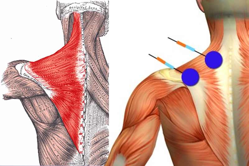 How do we treat spasmed neck muscles with manual therapy?